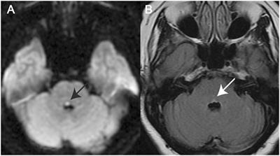 Preferential Impairment of the Contralesional Posterior Semicircular Canal in Internuclear Ophthalmoplegia